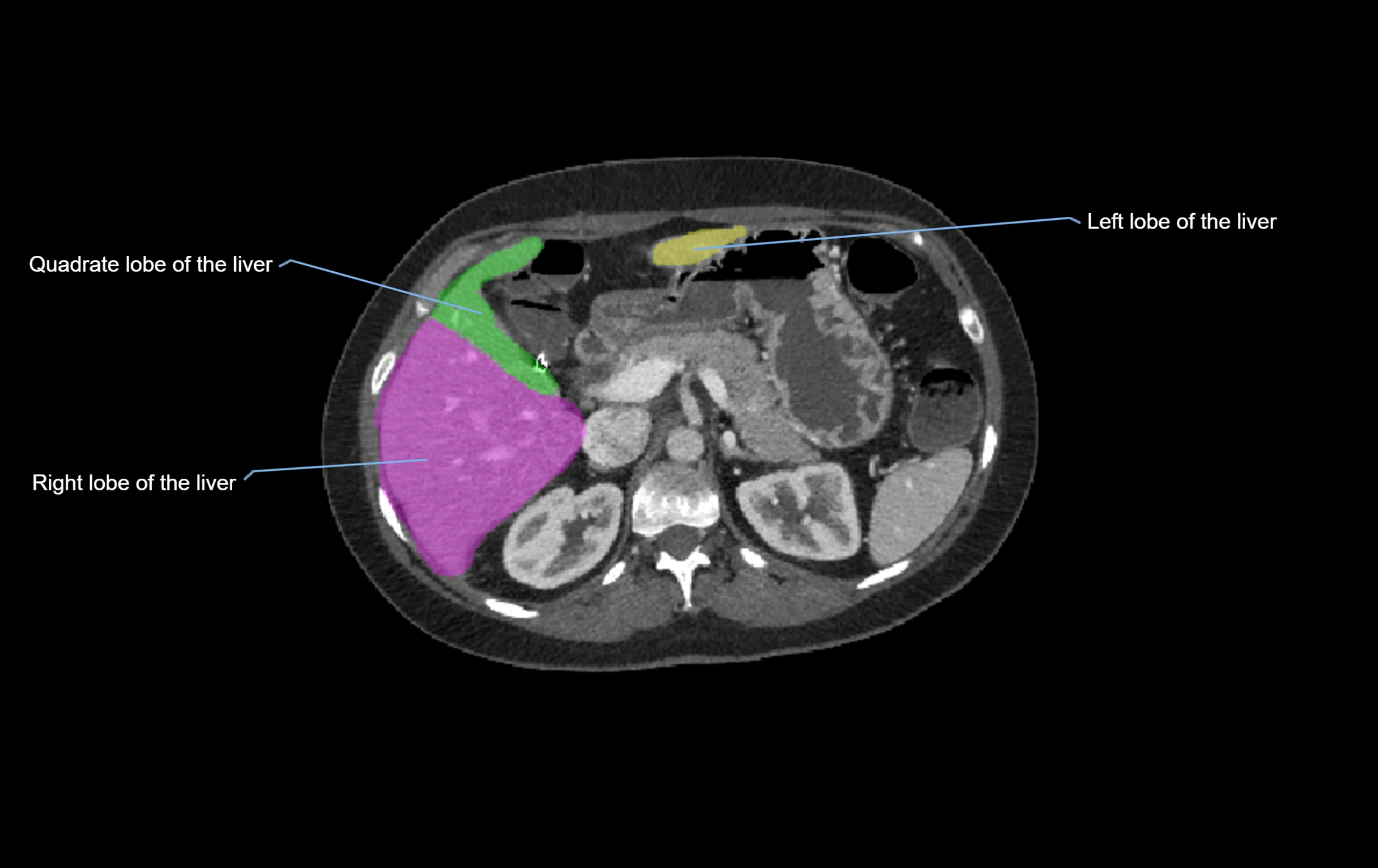 CT lliver lobes axial cross sectional anatomy labelled image -00039.webp